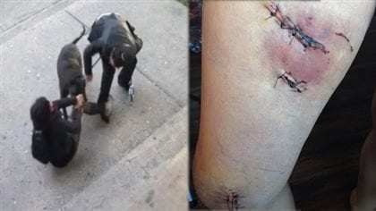 k sent a Montreal woman to hospital for three days.Two photos: on the left a woman is down on a sidewalk getting bitten on the leg and foot while a man tries top pull the dog away. On the right the scares on the bottom of her foot.