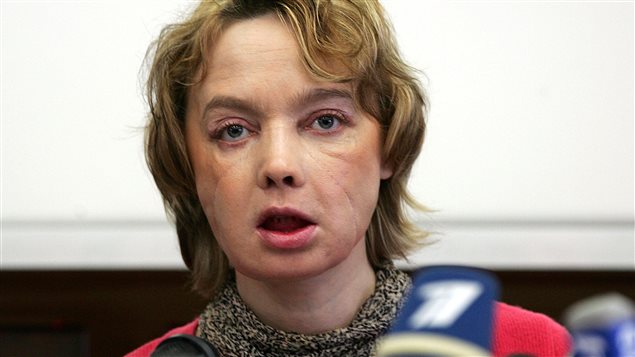 Isabelle Dinoire Isabelle Dinoire