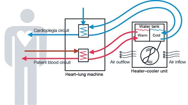 Blue arrows identify the cardioplegia circuit and shows cardioplegia solution entering the “heart lung machine.” Cardioplegia is used to stop the heart during surgery.Rectangles with zigzag lines are heat exchange coils. They separate heater-cooler fluid flow from patient fluid or blood flow.Red arrows identify the patient blood circuit and shows hot water flow and patient blood flow.Additionally, the water in the heater-cooler device is isolated from the patient, cardioplegia solution and blood circuits.