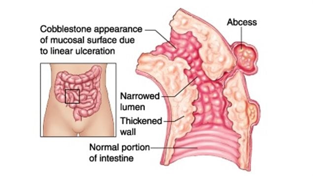 section of intestine showing inflammation from Crohn’s disease