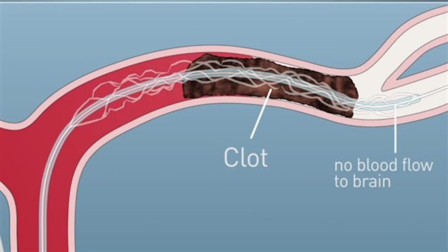 A blood clot can block the flow of blood to the brain resulting in the death of brain cells.