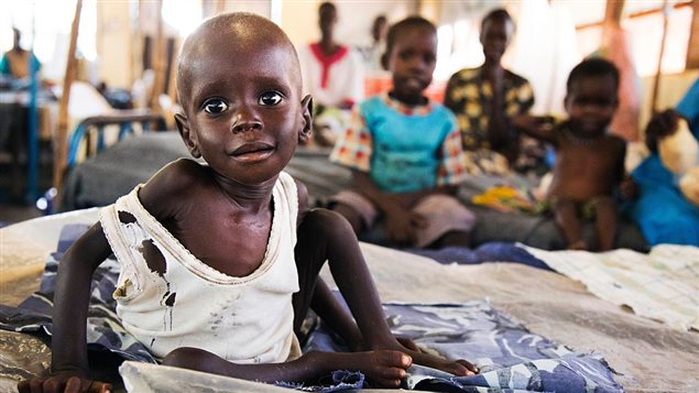 Aleo Tong (1), who suffers severe malnutrition, rests on a bed at the MSF Nutrition centre in Aweil Hospital, on 2 August, 2016. UN agencies warn that almost 5 million people in South Sudan urgently need food, agriculture and nutrition assistance.