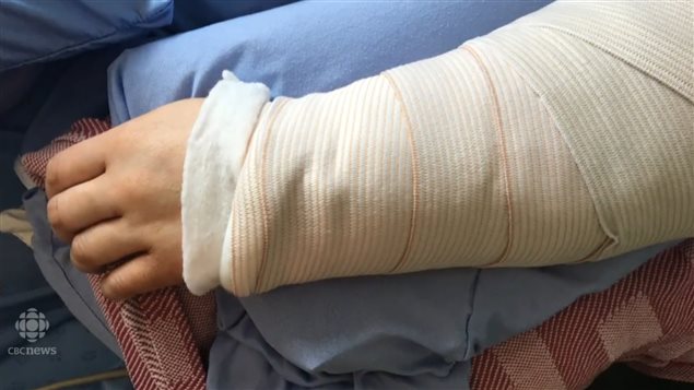 埃德蒙顿警方抓获打断这位少妇双臂的犯罪嫌疑人