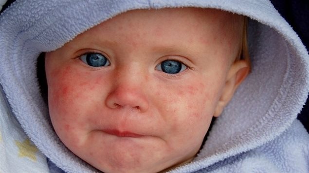 One symptom of measles is a red rash but the disease can also cause complications especially dangerous to the very young and those who are immune-compromised.