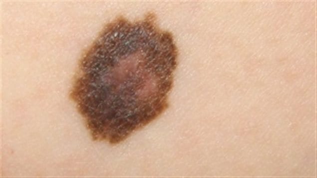 An uneven border and varied colours are some of the hallmarks of melanoma. 