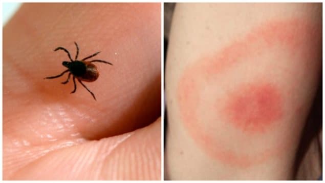 The bite of a tick causing Lyme disease will leave a rash in the form of a bull’s-eye.