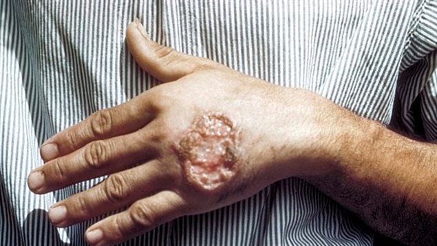 Skin ulcer due to leishmaniasis, hand of Central American adult