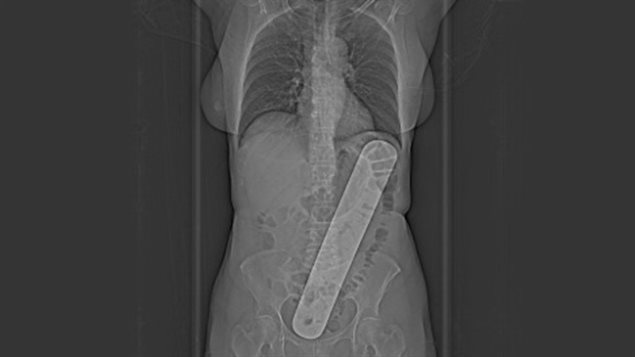 In March 2017, Patient Sylvia Dube suffered following an operation at a Montreal hospital. In june the pain had become intencse and X-rays later revealed a metal tool had been left in her abdomen