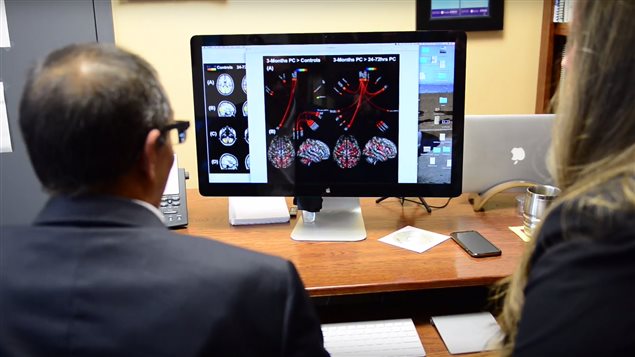Researchers used advanced MRI imaging techniques to study the post-concussion brains of young hockey players.
