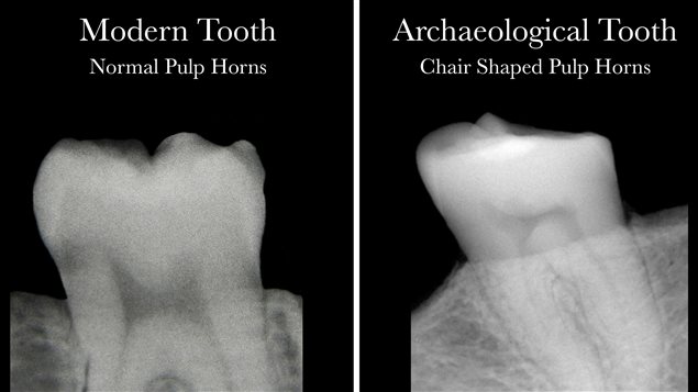 Left- with adequate vitamin D there are two clear horns and a semi-circular depression   Right-shows only one horn and a flat thin, chair-like image