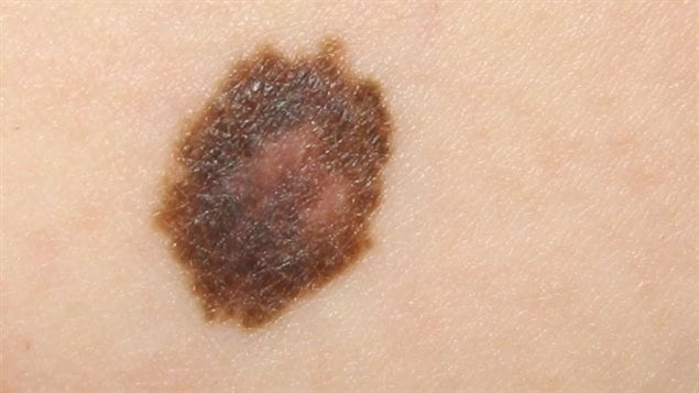 An innocent mole or skin cancer? Doctors visually inspect suspected cases and cancer is confirmed or ruled out with a painful biopsy, which involves cutting out a piece of the skin, The sKan could greatly reduce the number of unecessary biopsies, while also detecting actual lesions much earlier.