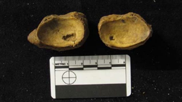 Bone chips were found in the foot bones of an older man buried in the Middenbeemster cemetery, The Netherlands.