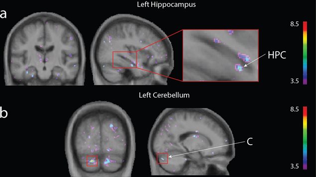 A significant effect was observed in the (a) left hippocampus and (b) left cerebellum.