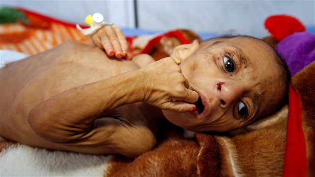 الطفلة اليمنية فاطمة عبد الله حسن البالغة من العمر سنة واحدة والتي تعاني من سوء تغذية حاد، طريحة الفراش يوم أمس في مركز للمعالجة في مدينة الحديدة اليمنية الواقعة على ساحل البحر الأحمر.