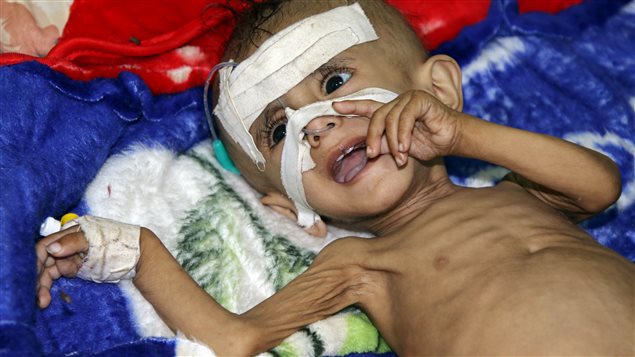 One-year-old Sameer al-Dhanbari, who suffers from severe malnutrition, lies on a bed at a hospital in Houta city, in the southern province of Lahej, Yemen December 5, 2017.