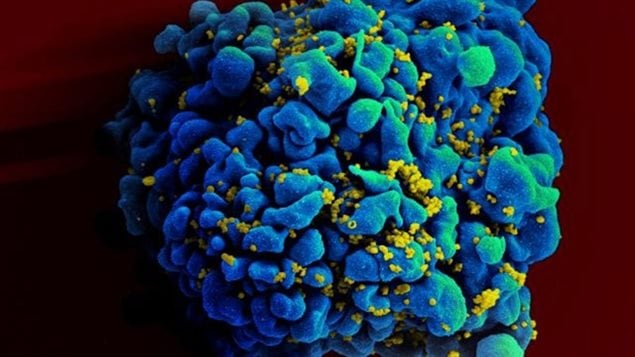 This electron microscope image shows an H9 T cell, blue, infected with the human immunodeficiency virus (HIV), yellow. Researchers in Ottawa are investigating the potential of another virus to target and destroy HIV-infected cells. 