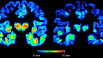 cerveau-alzheimer-cortex