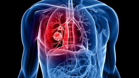 poumon-cancer-tumeurs
