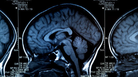 Un scan du cerveau