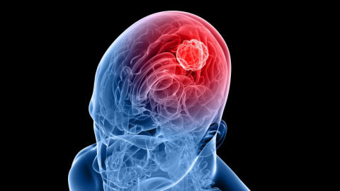 Des tumeurs différentes selon l'âge | Radio-Canada