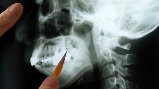 Radiographie d'une mâchoire humaine