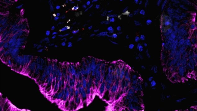 Cancer colorectal humain et les cellules immunitaires
