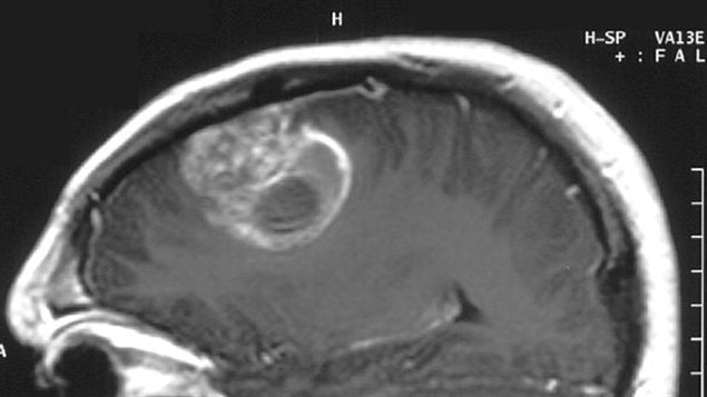 IRM cérébrale montrant un glioblastome chez un enfant de 15 ans.