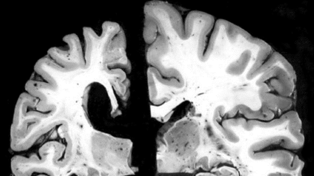 À gauche, le cerveau d'une personne de 70 ans atteinte de l'alzheimer. À droite, le cerveau d'une personne de 70 ans qui ne présente aucune trace de la maladie.
