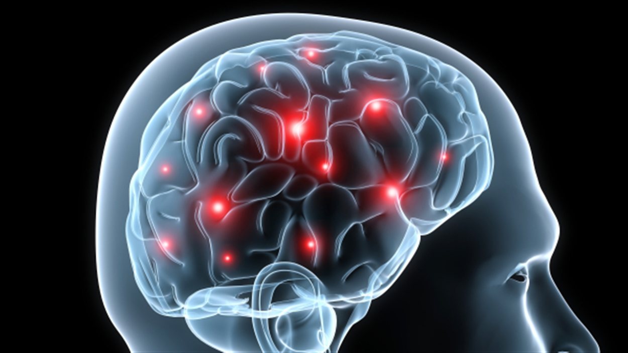 Stimuler le cerveau pour traiter la dépression sévère RadioCanada