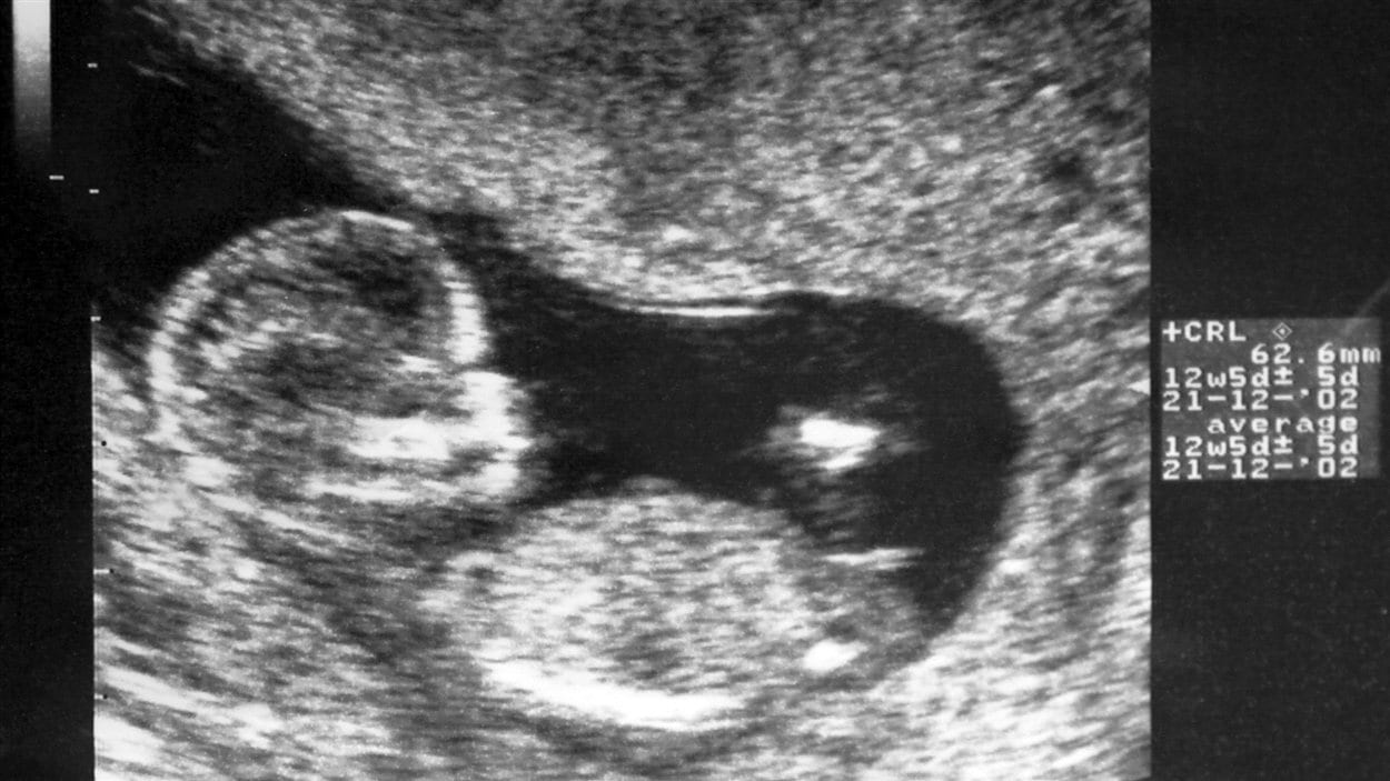 Un foetus à la 13e semaine de grossesse