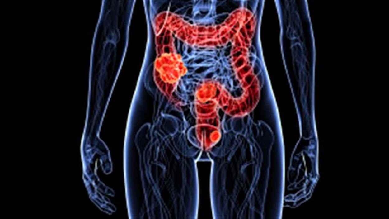 Cancer du colon