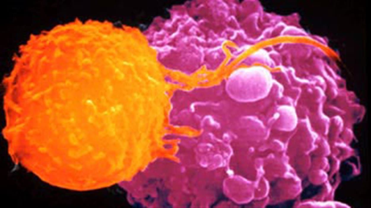 Une cellule lymphocyte T (en orange) attaque une tumeur cancéreuse (en rose)