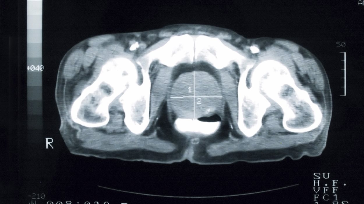 Cancer de la prostate : un test pas toujours bénéfique | Radio-Canada