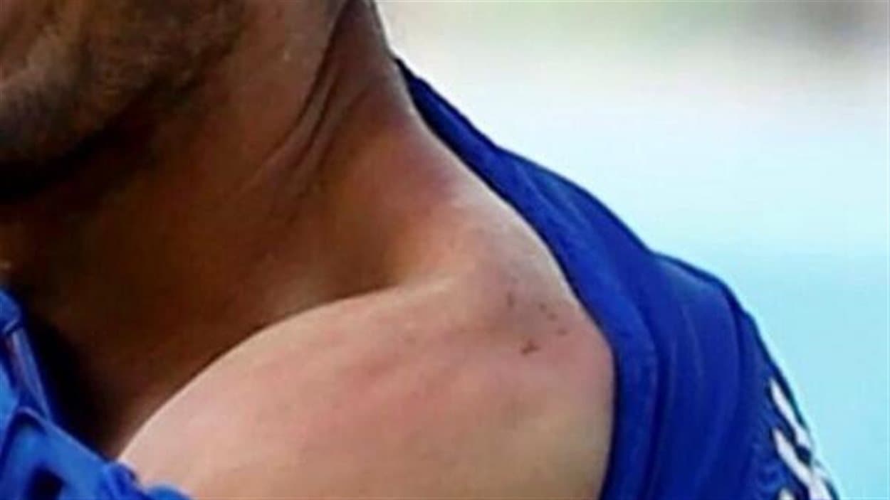 La morsure de Giorgio Chiellini