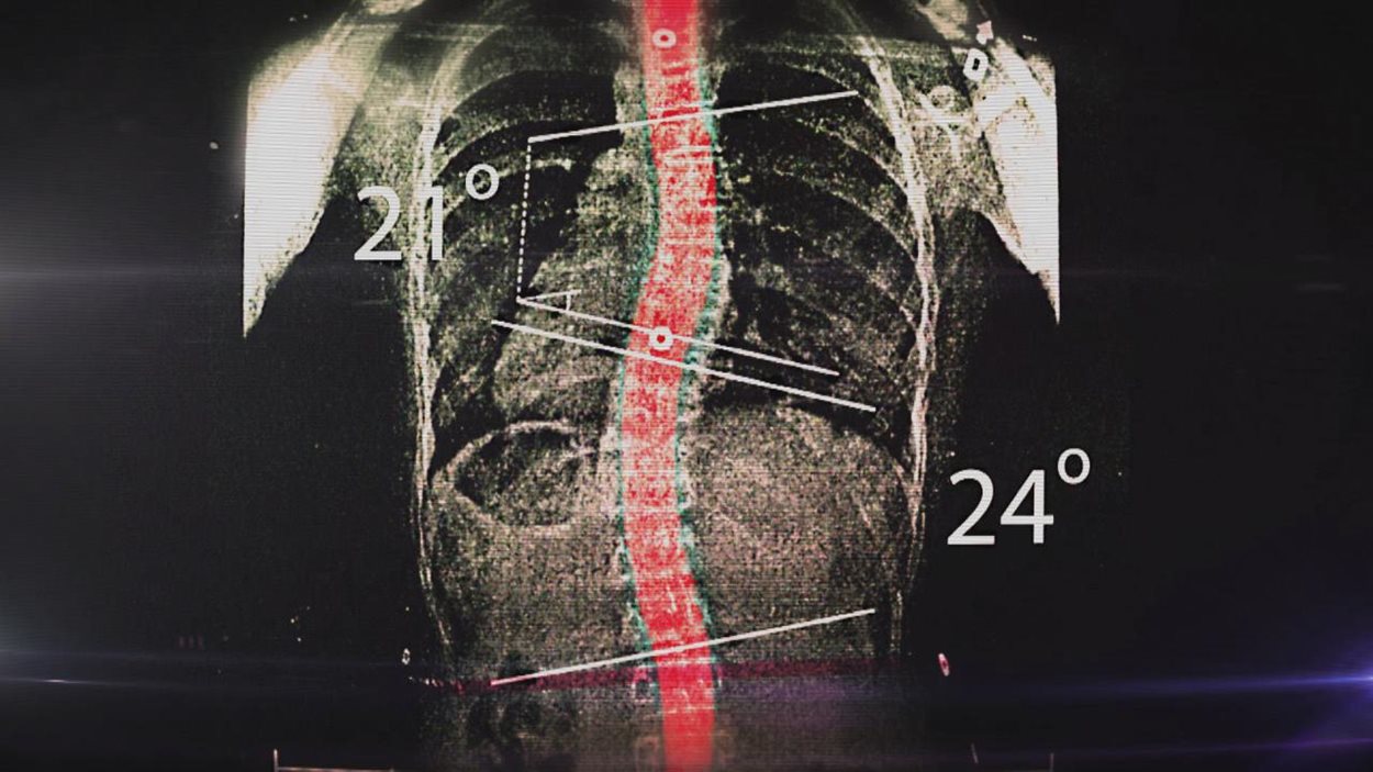 Un éminent chirurgien orthopédiste ainsi qu'une agente de recherche de l'hôpital Sainte-Justine se sont emballés pour leur invention, un corset souple permettant de corriger la courbure de la colonne vertébrale d'enfants atteints d'une scoliose.
