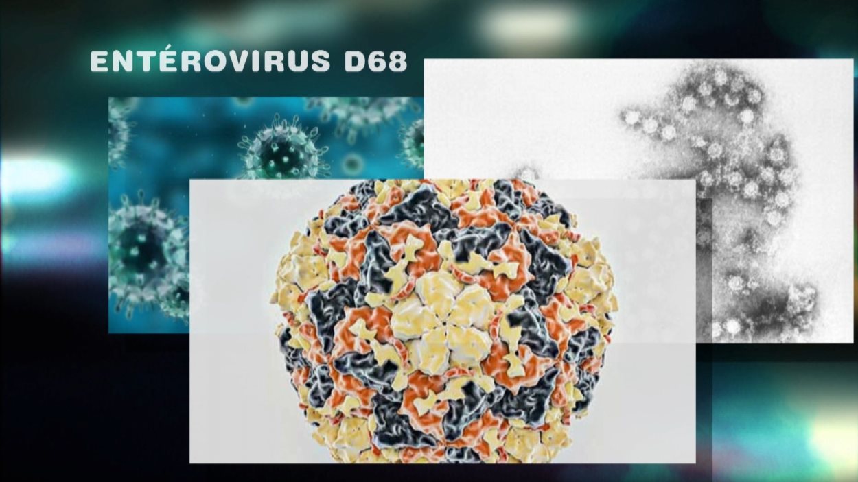 C.-B. : Augmentation Des Cas D'entérovirus D68 | Radio-Canada