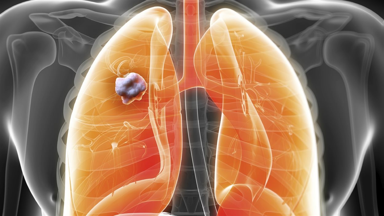 Cancer du poumon : mise au point d'un test de dépistage précoce | Radio ...