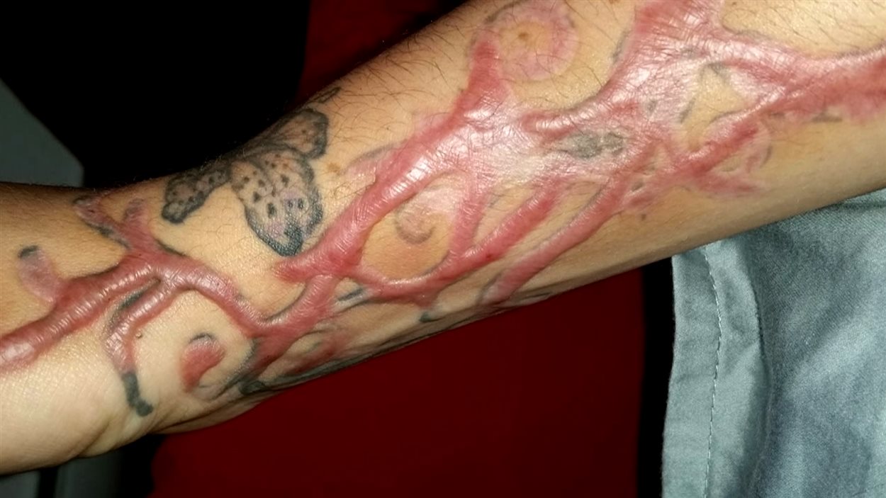 Magalie Courtemanche voulait faire disparaître son tatouage. Elle se retrouve avec quelque chose d'encore plus visible : une immense cicatrice sur l'avant-bras.