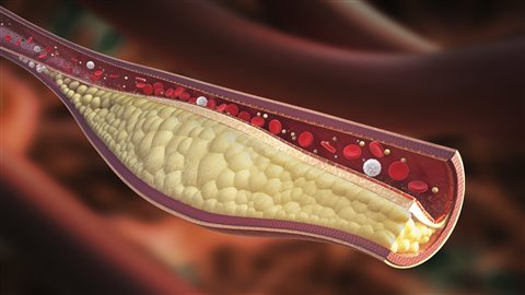 Un nouveau médicament prometteur pour traiter l’hypercholestérolémie ...