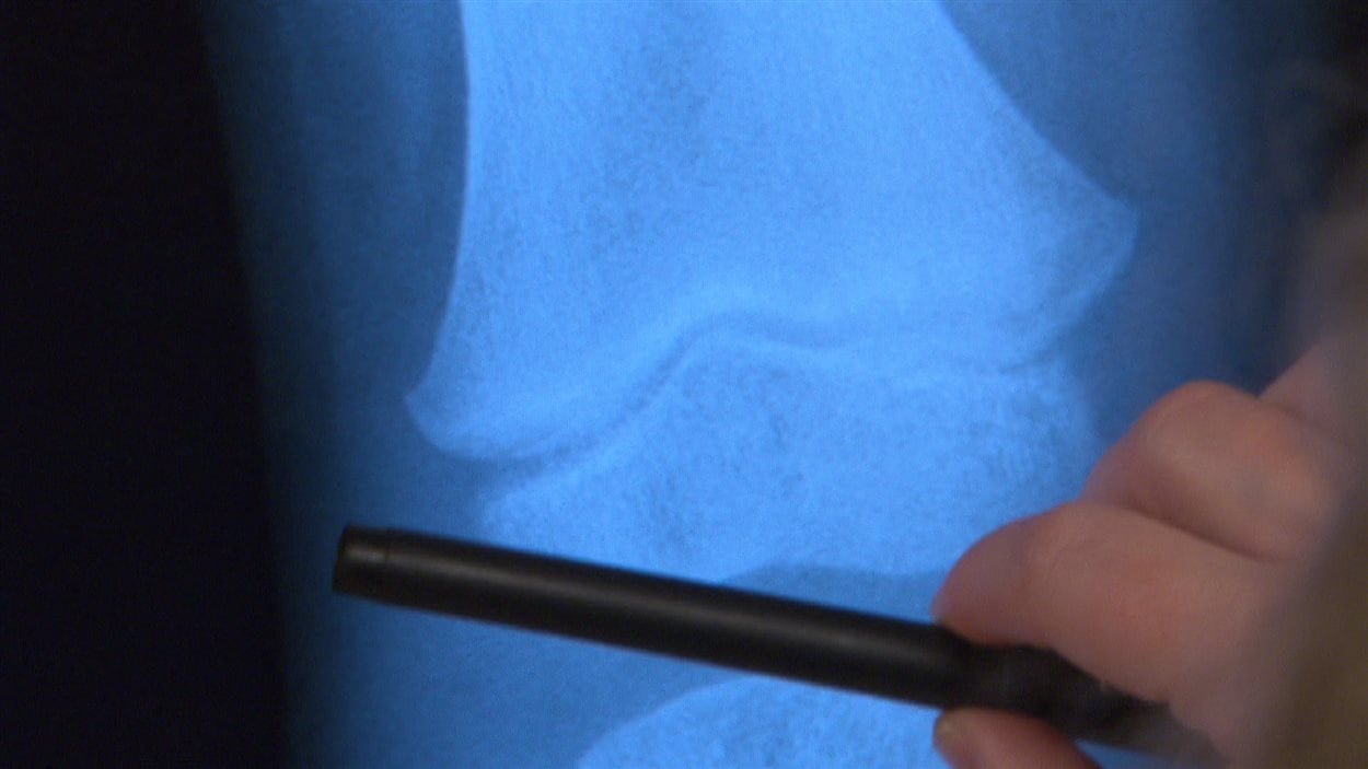 Gros plan d'une radiographie de la jambe d'un enfant atteint de rachitisme