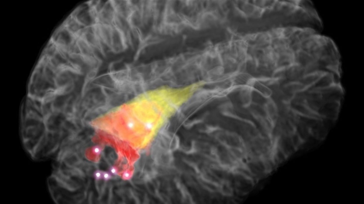 Image 3D d'un cerveau où une tumeur cancéreuse a été détectée