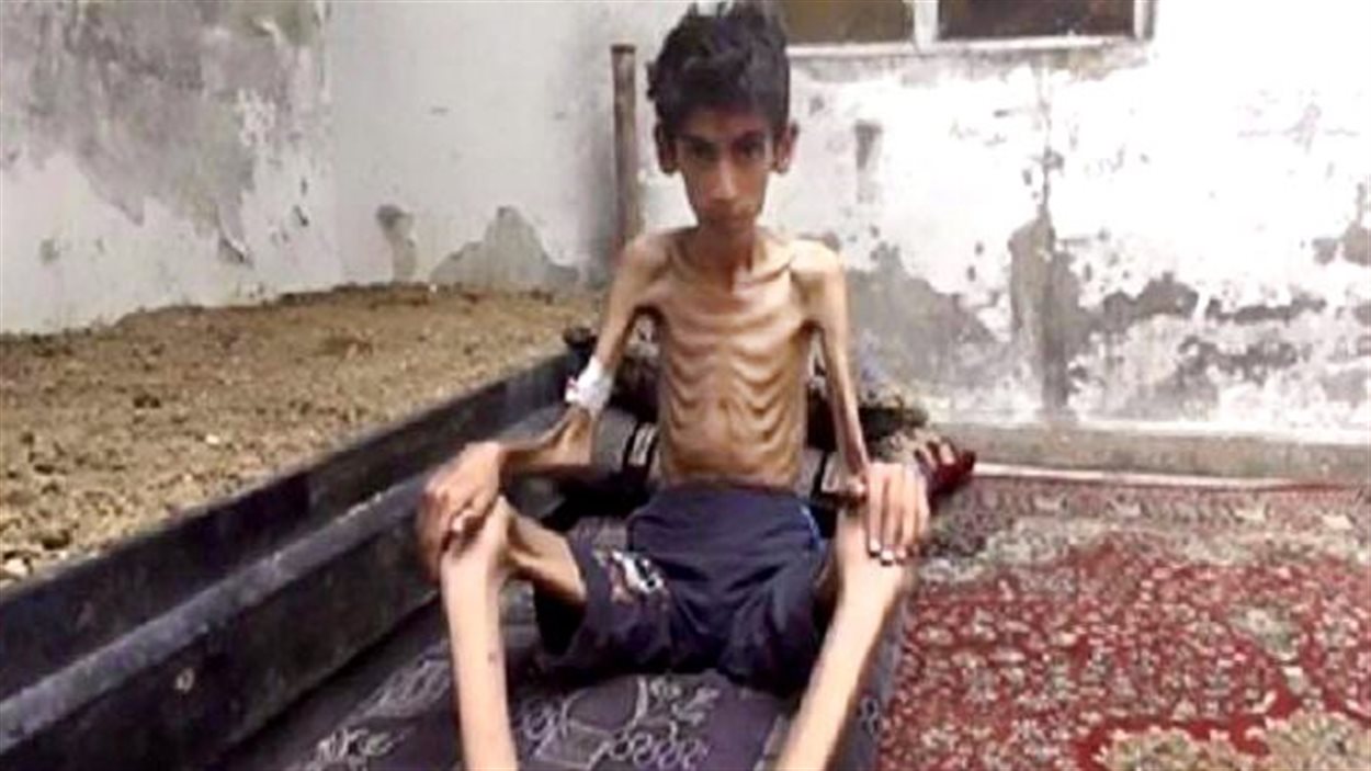 Cette photo non datée diffusée par le Conseil révolutionnaire local de Madaya montre un garçon amaigri jusqu'aux os. Associated Press affirme avoir vérifié l'authenticité de cette photo.