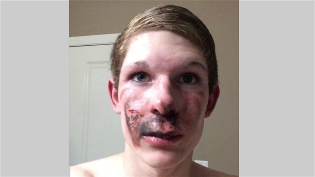 Un jeune gravement brl au visage par une cigarette lectronique, dit son pre | Radio-Canada Un jeune gravement brl au visage par une cigarette lectronique, dit son pre | Radio-Canada
