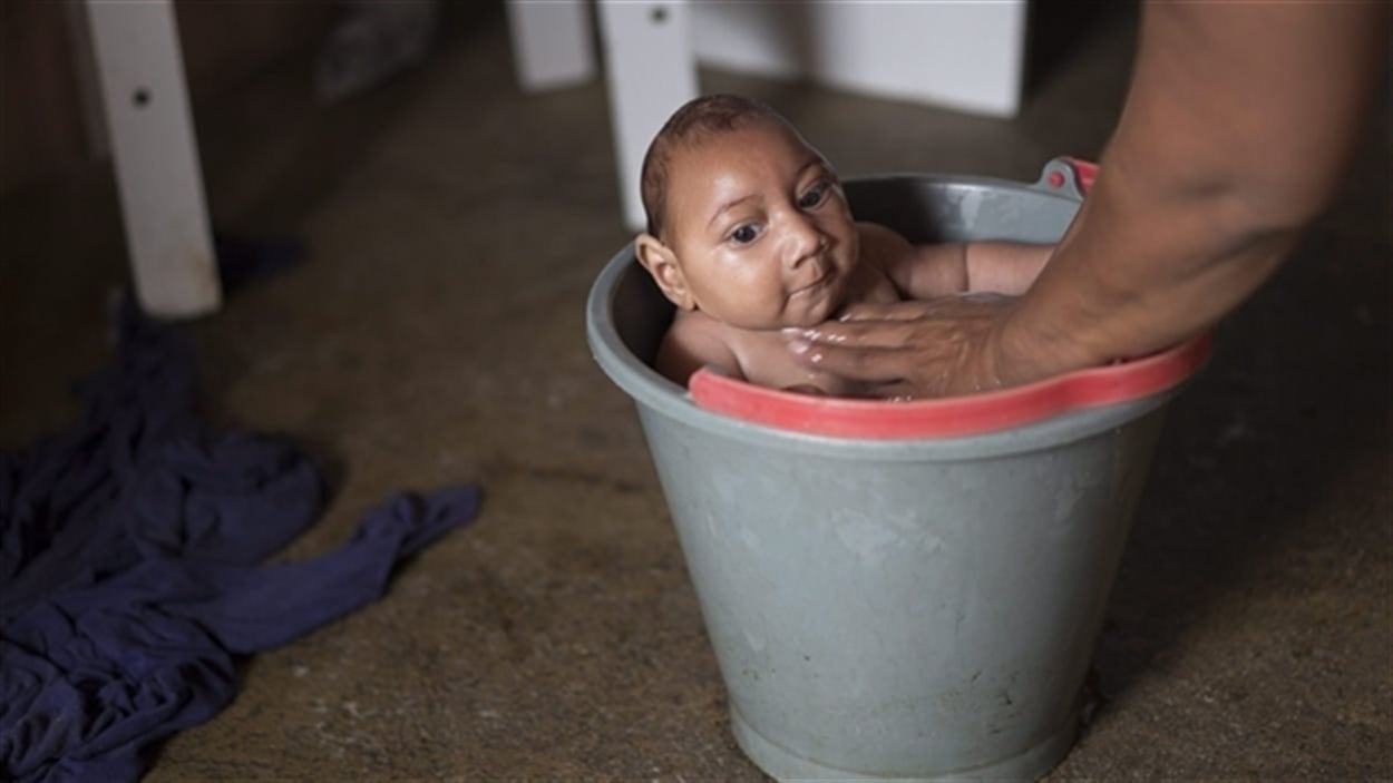 Bébé brésilien atteint de microcéphalie, né d'une mère infectée par le virus ZikaBébé brésilien atteint de microcéphalie, né d'une mère infectée par le virus Zika Photo : PC/AP/Felipe Dana