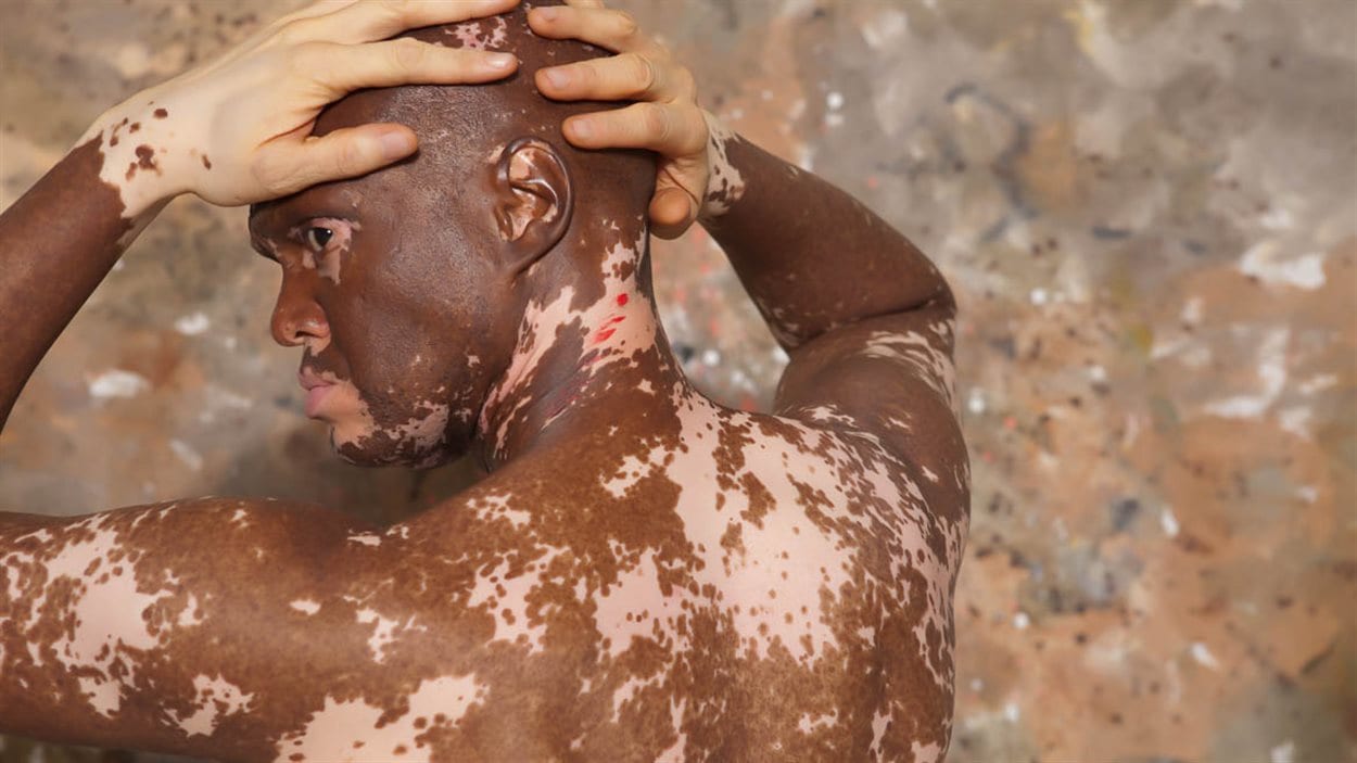 Vitiligo la maladie qui d colore la peau Radio Canada