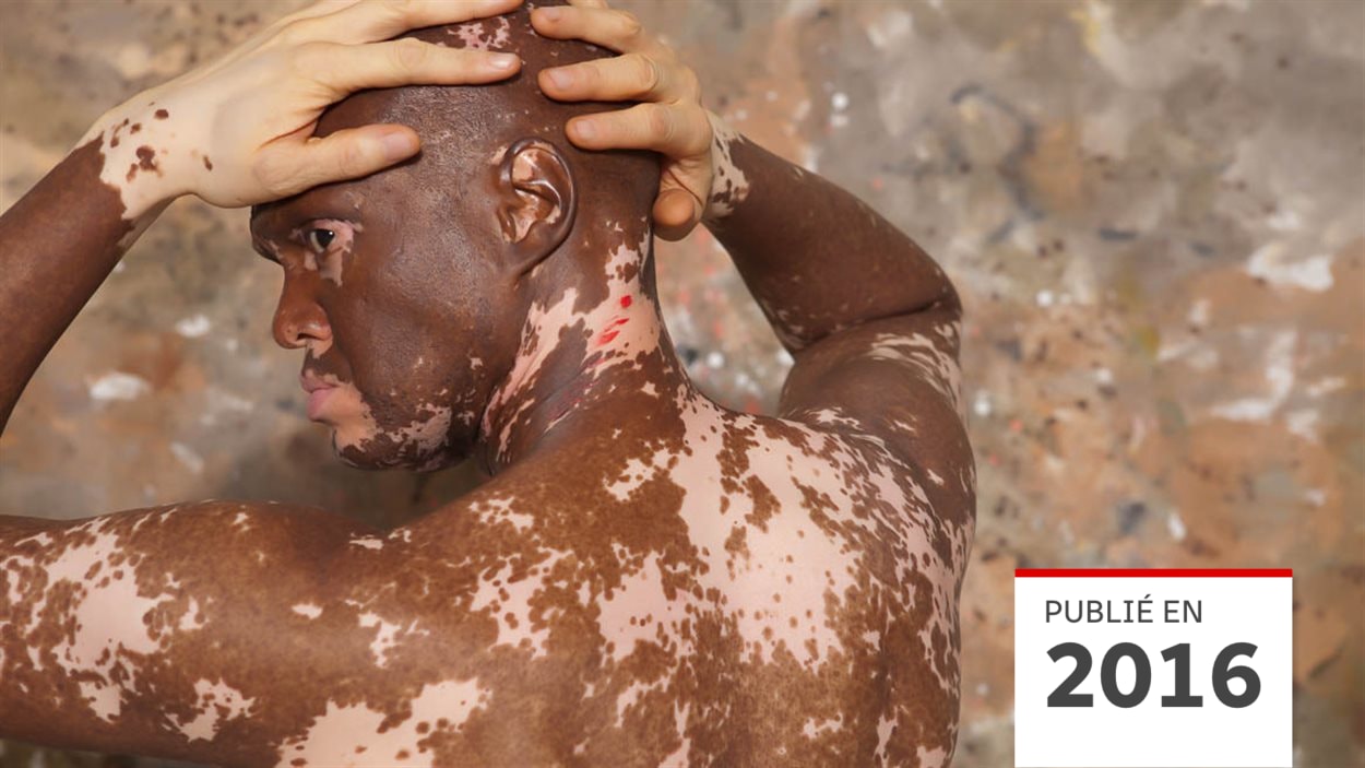 Vitiligo, la maladie qui décolore la peau | Radio-Canada