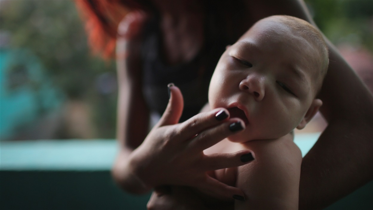 Un Premier Foetus Atteint D Anomalies Congenitales Liees Au Zika Au Canada Radio Canada Ca