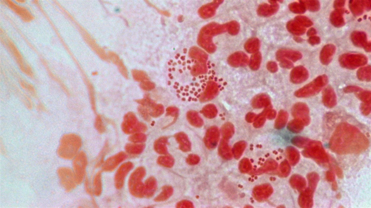 Une culture de gonorrhée résistante aux antibiotiques, vue sous la lentille d'un microscope