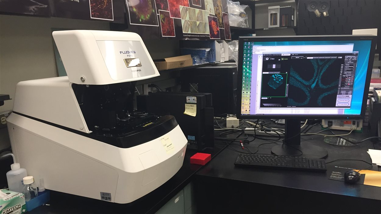 Sclérose en plaques l'Université de Calgary fait le point sur ses